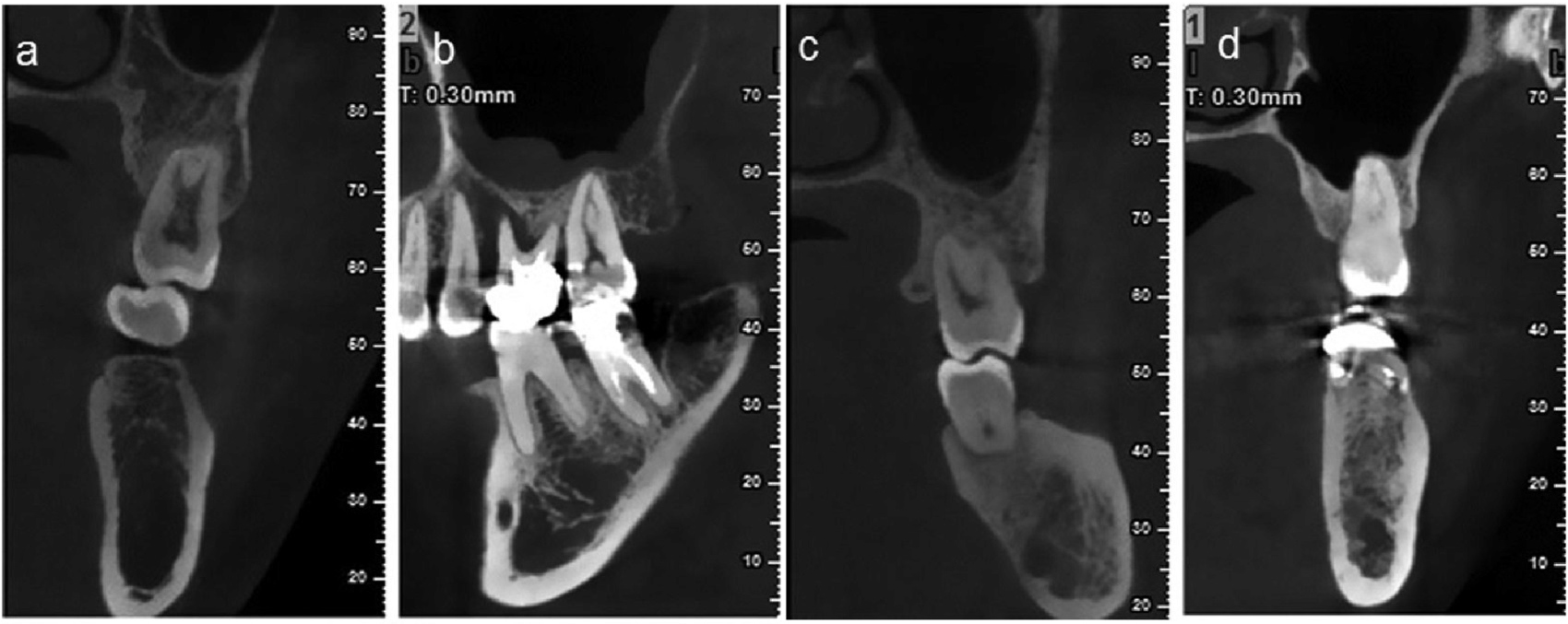 Access Endodontics - Dr. Lee - Advanced Technology 3D Imanging-2